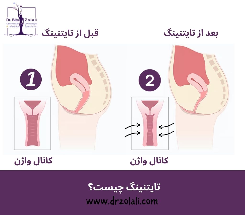 تایتنینگ یا تنگ کردن واژن چیست؟ تایتنینگ واژن با لیزر در تهران | دکتر زلالی